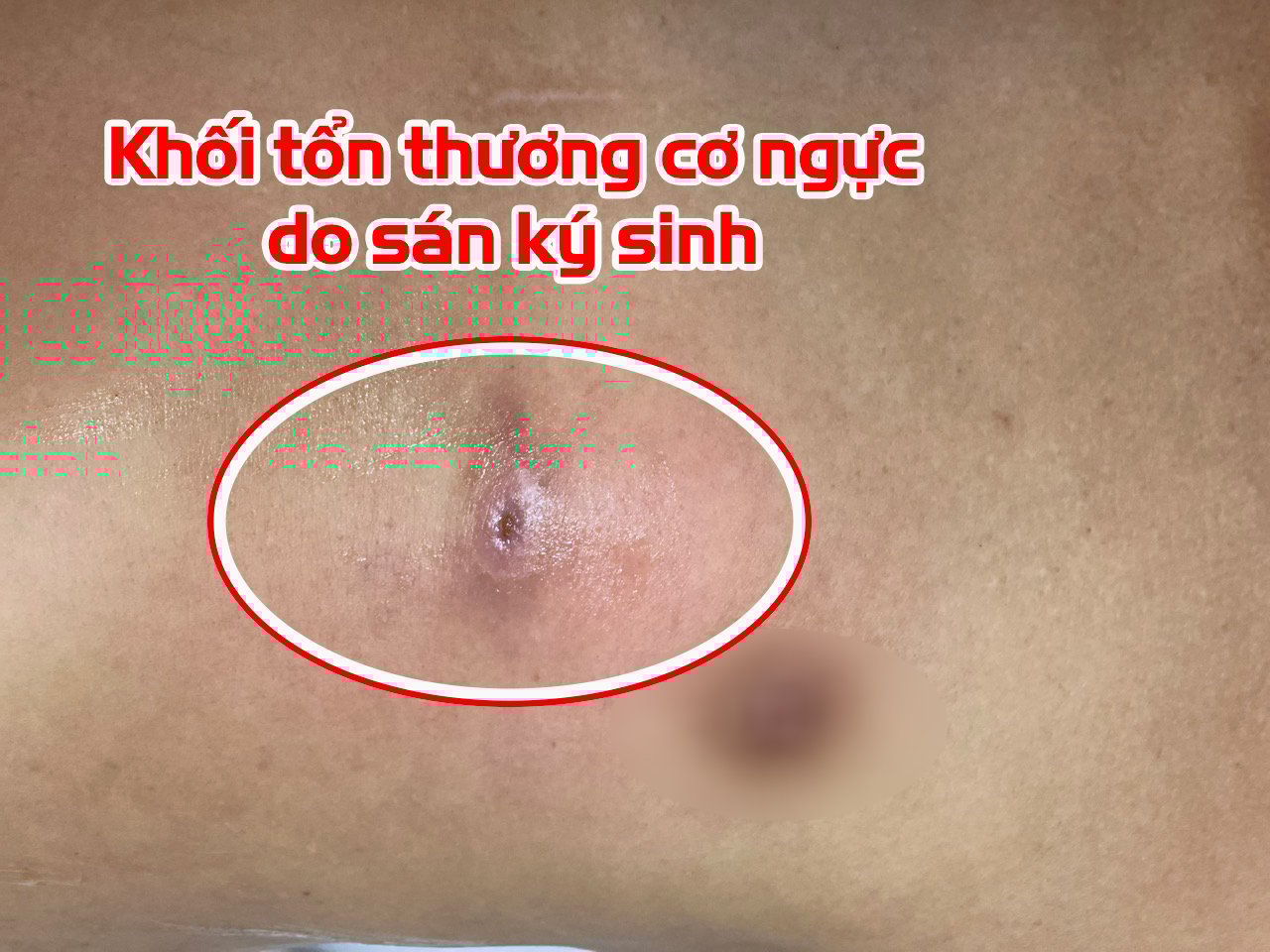 Sán não ký sinh khắp cơ thể người đàn ông